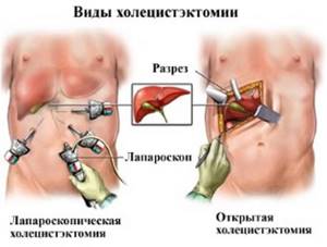Лапароскопия и полостная операция