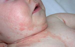 Детский токсико-аллергический дерматит