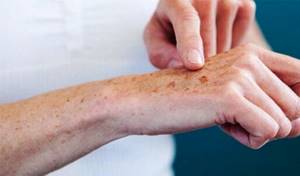 Высококвалифицированный специалист при жалобах пациента на пятна на коже наверняка назначит дополнительные анализы и обследования, чтобы выявить первопричину такого симптома.