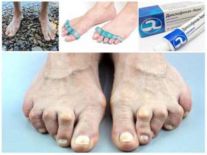 Лечение молоткообразных пальцев на ногах