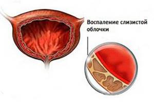 Цистит с кровью при мочеиспускании: лечение и причины