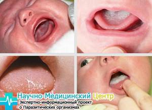 Кандидоз полости рта – причины появления, симптомы, диагностика и лечение