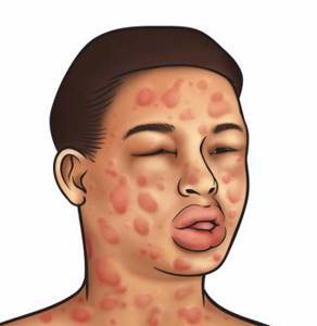 Аллергическая реакция у человека