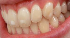 кариес на стадии пятна на молочных и коренных зубах