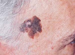 Кератома: фото – что это такое и как лечить кератому кожи?