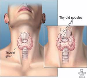 Варианты локализации кист щитовидной железы