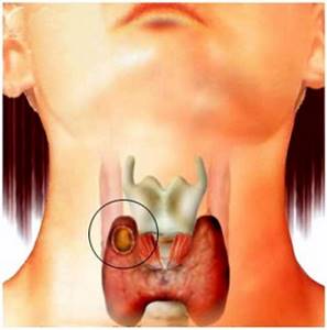 Киста щитовидной железы: причины возникновения, симптомы, виды кисты, диагностика и лечение