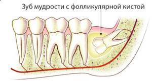 Фолликулярная киста зуба
