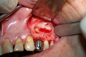 Киста зуба – симптомы и избавление от непредсказуемой патологии