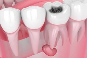 Киста зуба – симптомы и избавление от непредсказуемой патологии