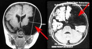 Врожденная арахноидальная киста головного мозга