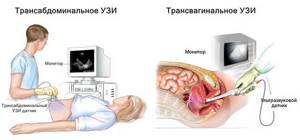 Когда лучше делать гинекологическое УЗИ: расшифровка и норма диагностики органов малого таза (ОМТ) и мочеполовой системы у женщин