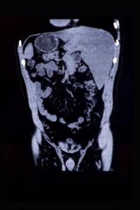 компьютерная томография кишечника в москве