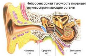 Кондуктивная тугоухость (кондуктивное снижение слуха, тугоухость по кондуктивному типу)