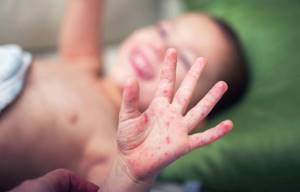 Корь у детей: фото начальной стадии сыпи, симптомы и общие признаки болезни у ребенка