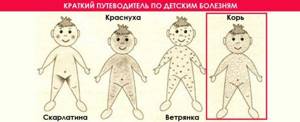 Корь у детей: фото начальной стадии сыпи, симптомы и общие признаки болезни у ребенка