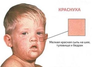 Коревая краснуха у ребенка. Симптомы, стадии, фото, лечение. Профилактика у детей
