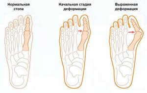 Вальгусная деформация большого пальца стопы