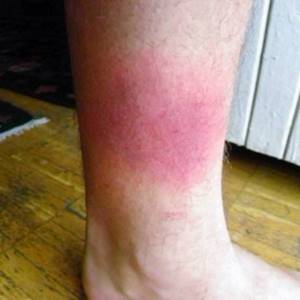Красные пятна на ногах: причины появления