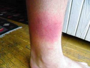 Красные пятна на ногах: причины появления и натуральные средства по избавлению (53 фото)
