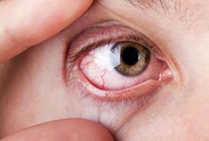 Красный глаз. Причины и лечение, как убрать аллергию, покраснение, воспаление