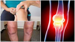 как лечить гонартроз коленного сустава в домашних условиях