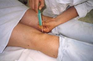 Лечение и виды операций по удалению кисты Бейкера коленного сустава