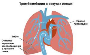 Тромбоэмболии легочной артерии