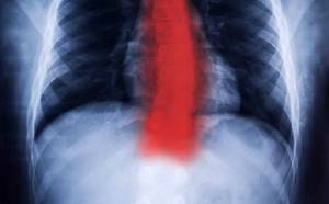 Рентген шейного и грудного отдела позвоночника