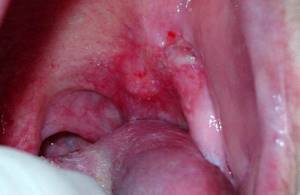 болезнь полости рта