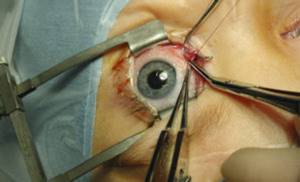 фото операции на глаза