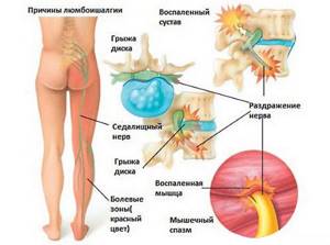 Чаще всего боль в нижней части спины возникает из-за межпозвоночной грыжи