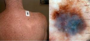 Меланома кожи: как выглядит, первые признаки, симптомы и лечение меланобластомы