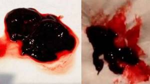 Сгустки крови во время менструации
