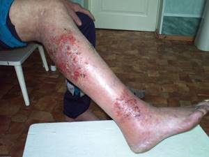 Симптомы микробной экземы на ногах