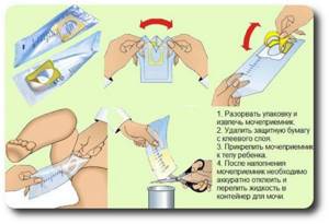 Инструкция-фото: Как пользоваться мочесборником для новорожденных девочек
