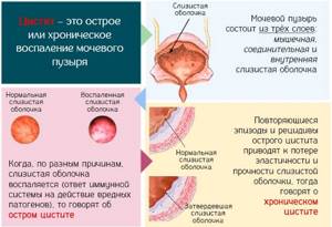 Мочевой пузырь у женщин. Где находится, строение, функции, симптомы болезней и лечение