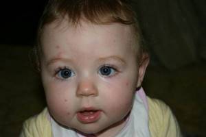 Моллюск на коже у ребенка: причины возникновения и лечение