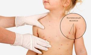 Моллюск на коже у ребенка: причины возникновения и лечение