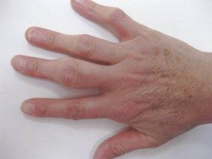 Методы лечения народными средствами артрита пальцев рук