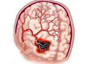 Нарушения артериального кровообращения мозга формы признаки лечение