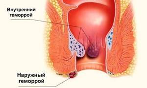 Наружный геморрой - болезнь, возникающая в результате нарушенного кровообращения в венах, расположенных в заднем проходе