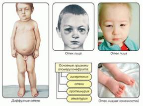 Нефритический синдром у взрослых и детей: симптомы и лечение