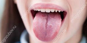 Возможная травма поверхни слизистой языка
