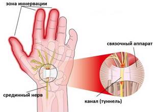 Немеют пальцы рук: причина и лечение: большой, мизинец, безымянный, указательный на левой и правой руке. С каким заболеванием связано