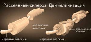 Немеют пальцы рук: причина и лечение: большой, мизинец, безымянный, указательный на левой и правой руке. С каким заболеванием связано