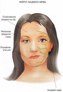 Невралгия лицевого нерва. Симптомы и лечение, народные средства, препараты