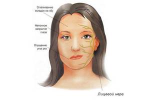 Неврит лицевого нерва или паралич Белла: что пошло не так и почему лицо «перекосило»?