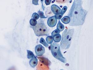 Мазок на флору у женщин. Норма, таблица, расшифровка лейкоциты, эритроциты, кокки, при беременности