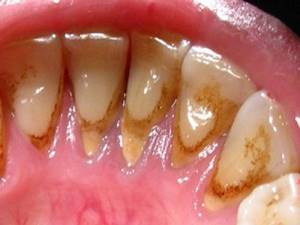 Зубной камень - одна из причин горечи во рту